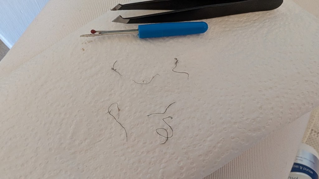 six black threads just removed from her foot